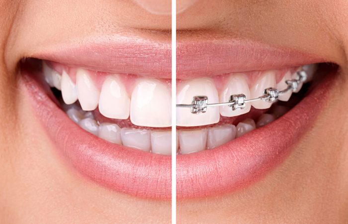 brackets metálicos