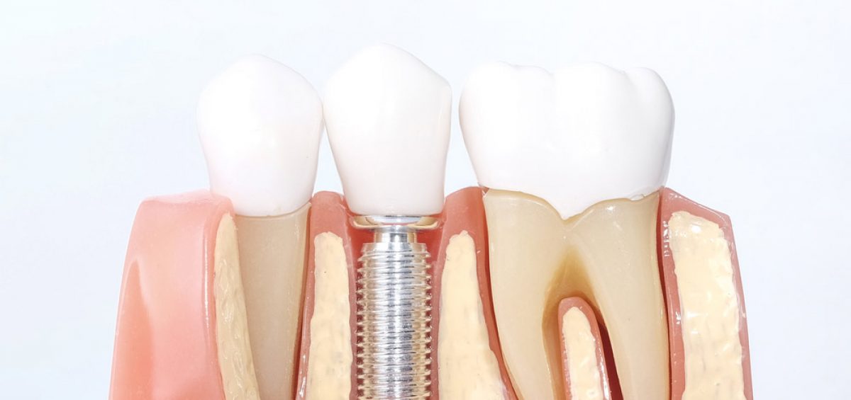 implantes dentales Sevilla