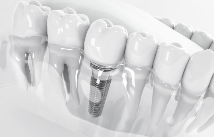 implantes dentales de carga inmediata