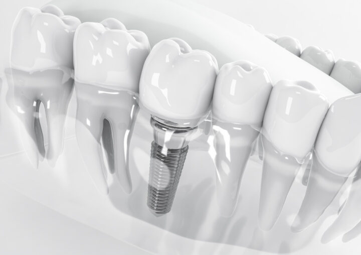 implantes dentales de carga inmediata