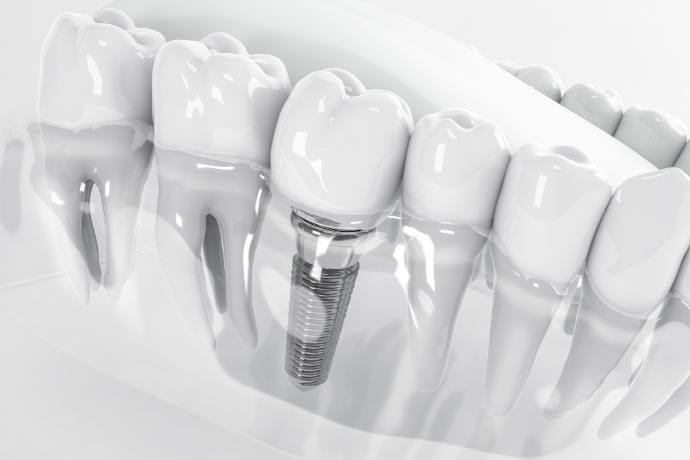 implantes dentales de carga inmediata