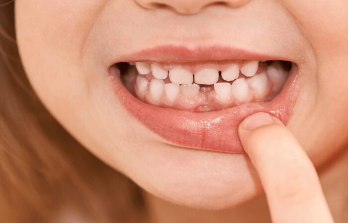 cuándo empiezan a caer los dientes de leche