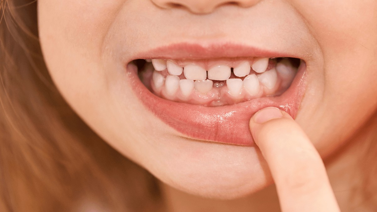 cuándo empiezan a caer los dientes de leche