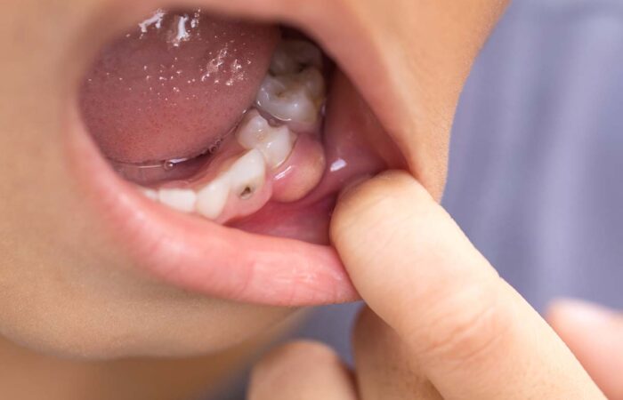 dientes picados en niños