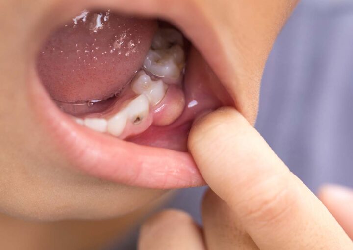 dientes picados en niños