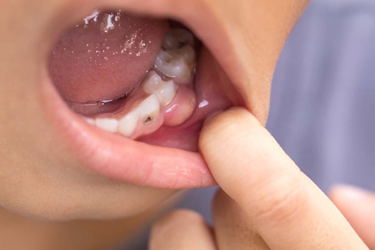 dientes picados en niños