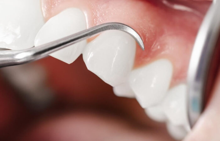 duele un curetaje dental
