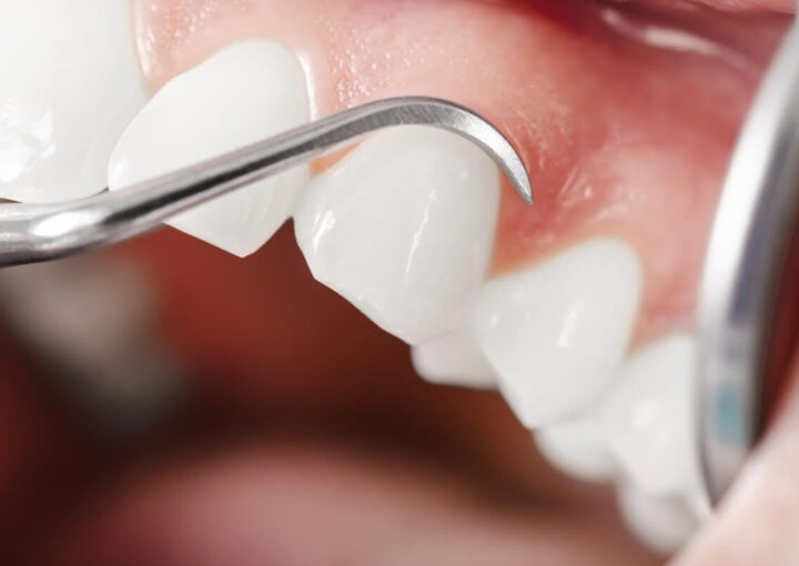 duele un curetaje dental