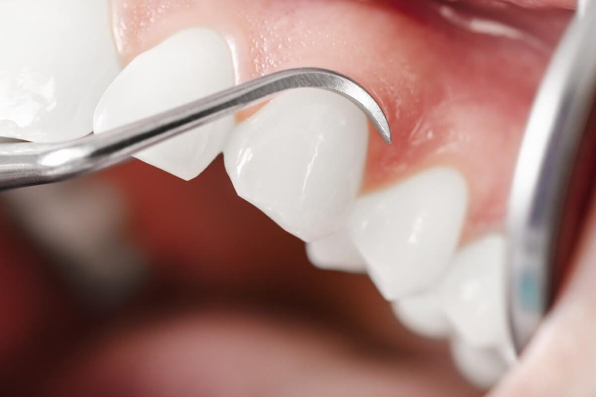 duele un curetaje dental