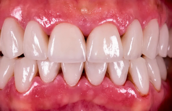 troneras dentales