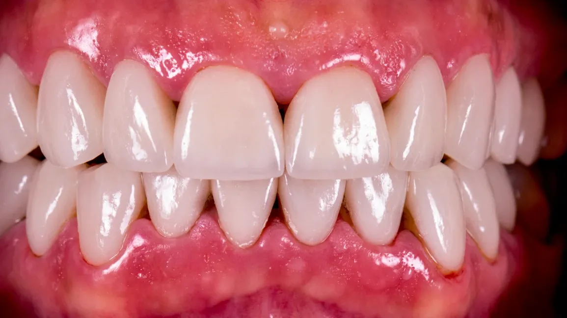 troneras dentales
